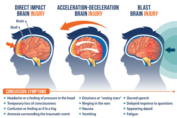 Illustration of Concussion and Concussion Symptoms